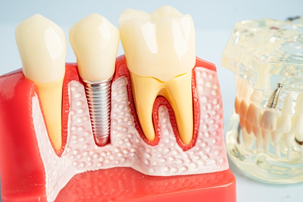 Benefits To Replace Missing Teeth With Dental Implants